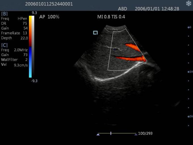 15” LCD Touch Screen Portable Ultrasound Scanner With 2-11 Mhz Probes 5Kgs Weight