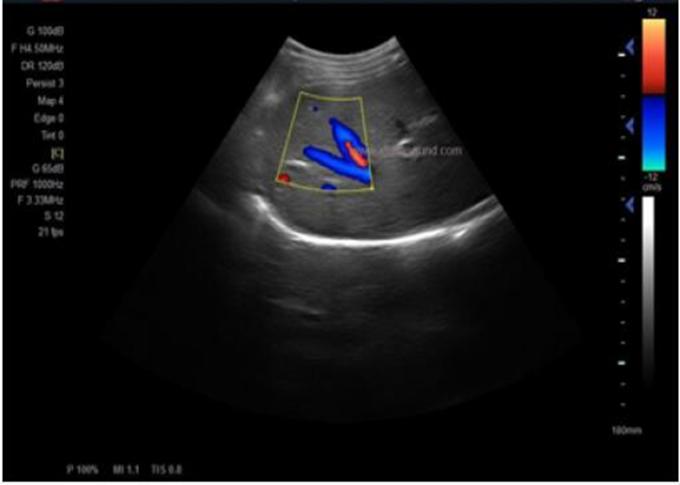 15” LCD Screen Portable Ultrasound Scanner Color Doppler With 2-12 Mhz Probes