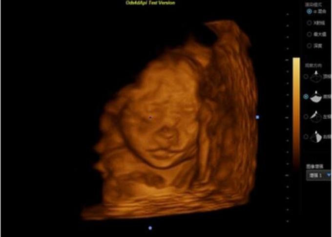 15” LCD Screen Portable Ultrasound Scanner Color Doppler With 2-12 Mhz Probes