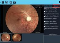 Software of Report Available Digital Fundus Camera Telemedicine Ophthalmic Device With Rechargeable Lithium Battery