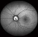 Confocal Retina Opthalmoscope Digital Fundus Camera With FOV 15°, 30°, 60° Image Size 1024*1024