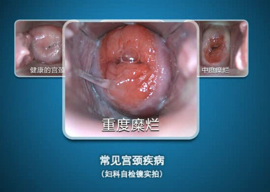 Digital Endoscope Self-Inspect Colposcope