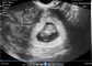 Transvaginal Endocavity Portable Pregnancy Scanner For OB / GYN Portable Ultrasound