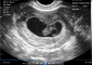 Transvaginal Endocavity Portable Pregnancy Scanner For OB / GYN Portable Ultrasound