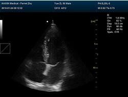 B Ultrasound Scanner Portable Ultrasound Scanner with Built-in 4D Module with Optional 4D Volume Probe