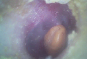 Handheld Digital Video Otoscope