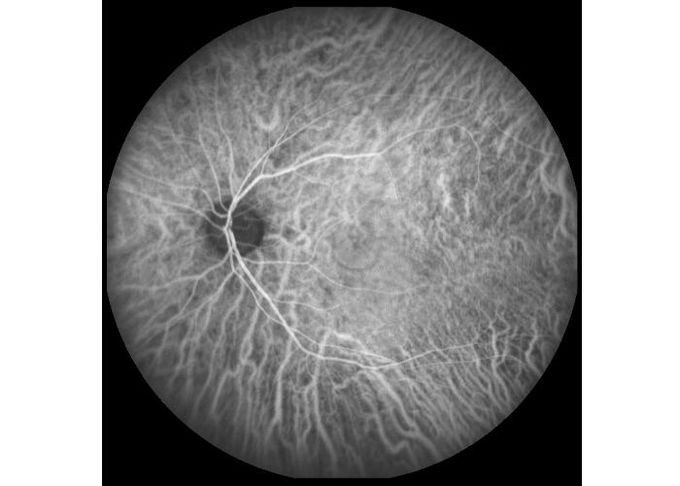 Ultra-wide Field Laser Scanning Retina Angiograph Digital Ophthalmic Equipment With Optical Zoom 100°/60°/30°