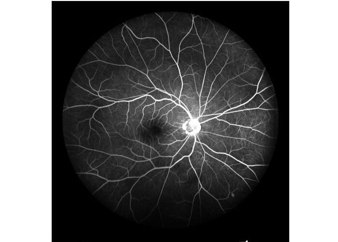 Ultra-wide Field Laser Scanning Retina Angiograph Digital Ophthalmic Equipment With Optical Zoom 100°/60°/30°